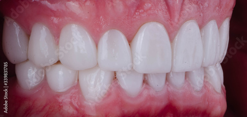 The Hollywood smile and healthy gum photo