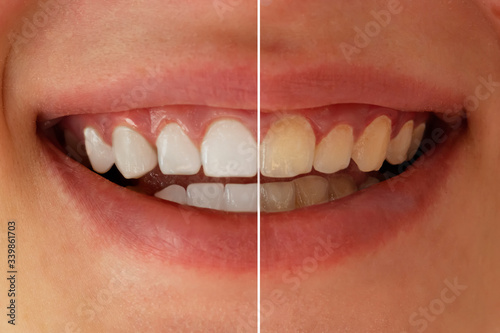 Teeth whitening before after. Woman teeth before and after whitening. Dental health concept. Oral care concept