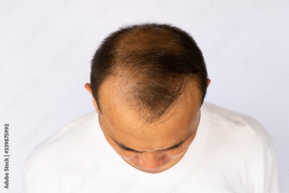 Obraz premium Hair loss Asian man showing all side of his bald head