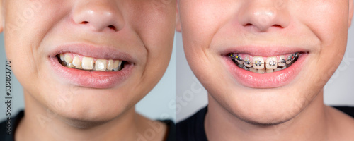 Close up view collage photography of smiling mouth of young white kid with overbite teeth before and after fixing metal modern braces construction on teeth. Shoot the same day.