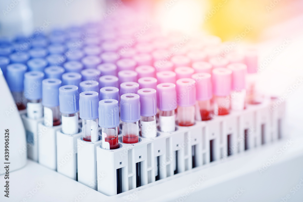 Lab worker preparing test blood for detection of antibodies and infections Corona virus Lab worker preparing test blood for detection of antibodies and infections Corona virus