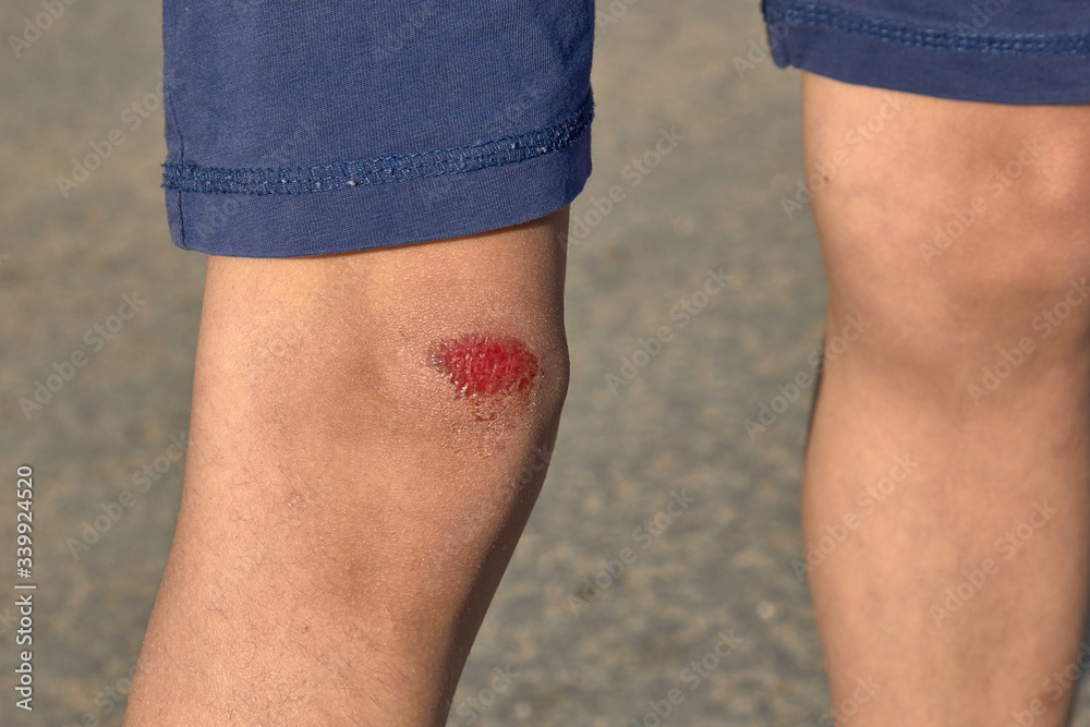 bruised wound on the knee, the boy fell and scratched his knee Stock