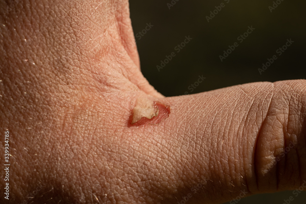 Fototapeta premium a burst Blister on a man's palm is caused by hard work