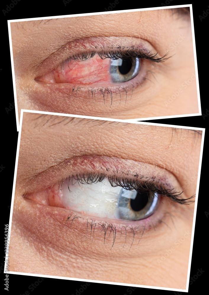 © Alessandro Grandini - Comparison closeup view of eye before and after eyedrop treatment. Female red irritated eye. Healthcare and eyecare concept... © Alessandro Grandini - Comparison closeup view of eye before and after eyedrop treatment. Female red irritated eye. Healthcare and eyecare concept...