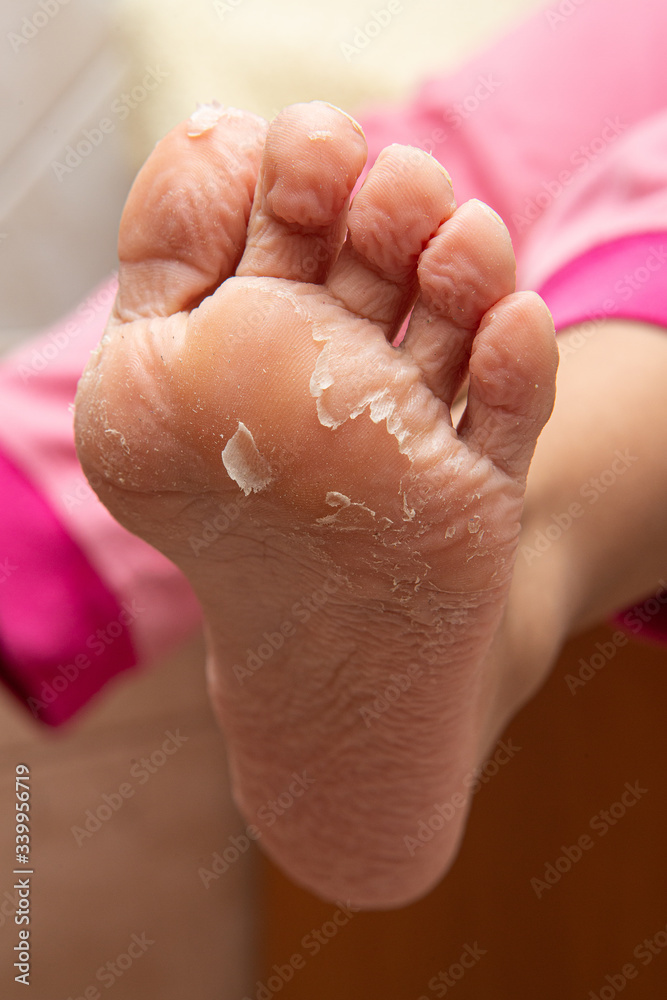 Close up of adult female foot with skin peeling off after bath. Damaged  derm peeling off. Health, skin and foot care concept... Stock Photo | Adobe  Stock