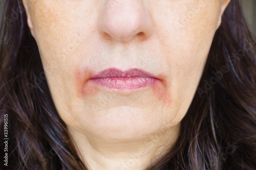 Perleche or perioral dermatitis: health professional with big red spots of inflamed skin around the corners. photo