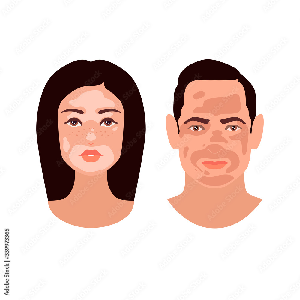 Beautiful European young woman and man faces with Vitiligo disorder texture. Skin condition that causes loss of melanin. Boy and Girl heads isolated on white background. Stock vector flat illustration