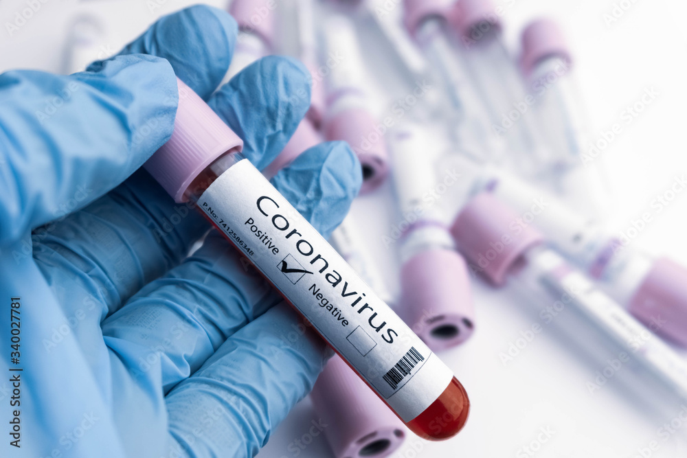 Positive COVID-19 test and laboratory sample of blood testing for diagnosis new Coronavirus outbreaking concept. Positive COVID-19 test and laboratory sample of blood testing for diagnosis new Coronavirus outbreaking concept.