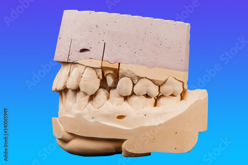 medicine, tooth, dentistry, impression, prosthesis, dentist, dental, cast, implant, denture, porcelain, mould, gum, colorful, clinic, dentition, chew, blue, mouth, square, endodontics, stone, conceptu photo