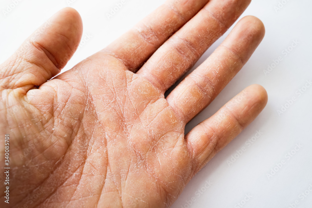Dry Man Hand Dry Man Hand