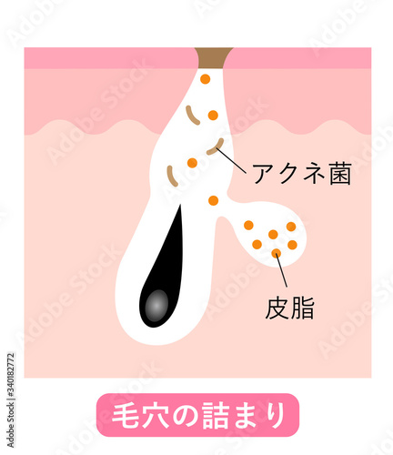 ニキビの初期症状　肌の断面図