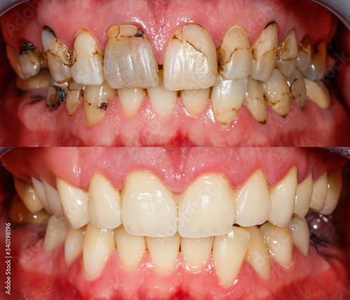 Teeth before and after treatment