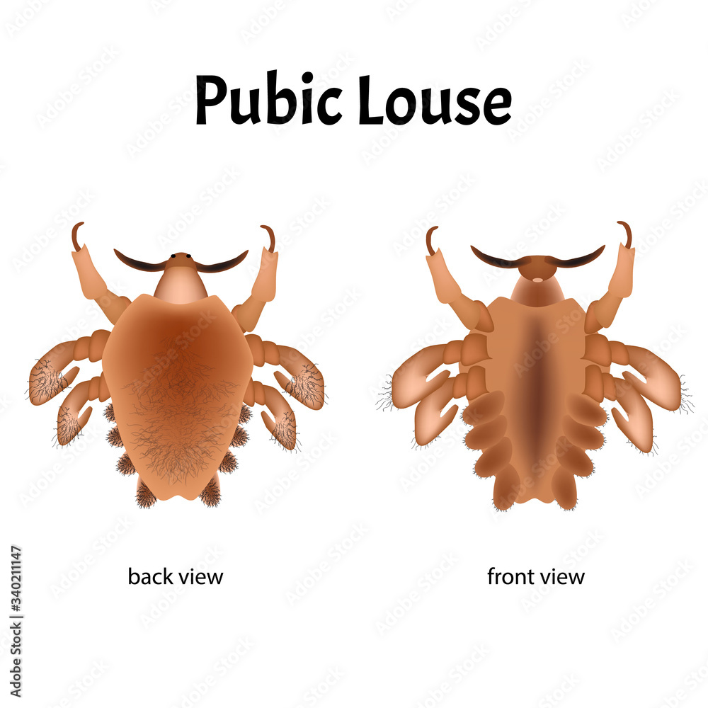 Vecteur Stock Parasitic diseases of Phthiriasis. Pediculosis pubis