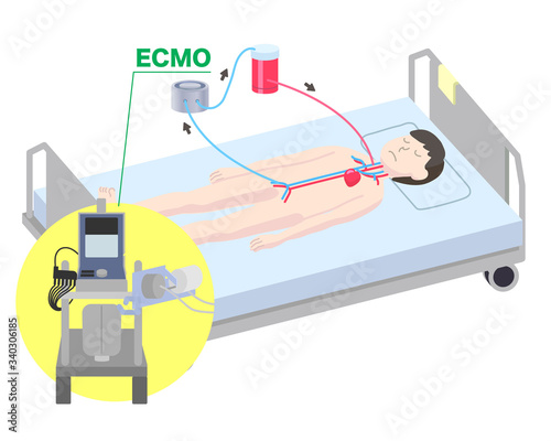 体外式膜型人工肺図解イラスト

