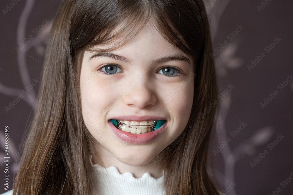 Little girl shows orthodontic apparatus in the mouth, malocclusion, pediatric orthodontics