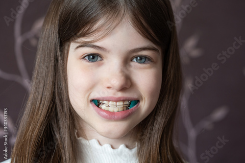 Obraz na płótnie Little girl shows orthodontic apparatus in the mouth, malocclusion, pediatric orthodontics w salonie
