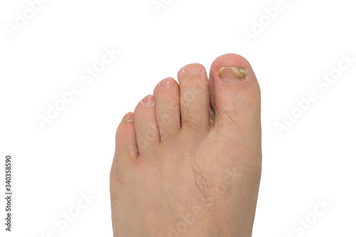 Fungus of toenails and human skin.