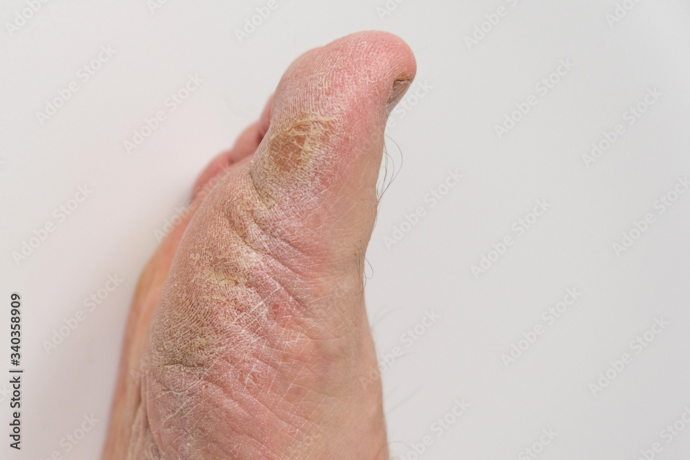 Fototapeta premium Fungus of the foot of a person.