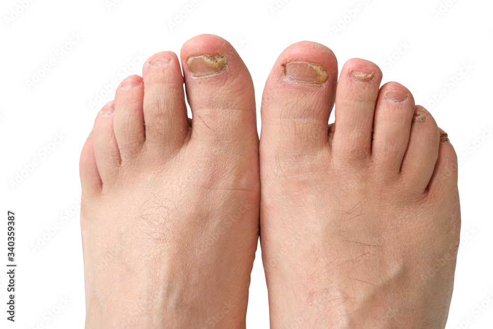 Fototapeta premium Fungus of toenails and human skin.