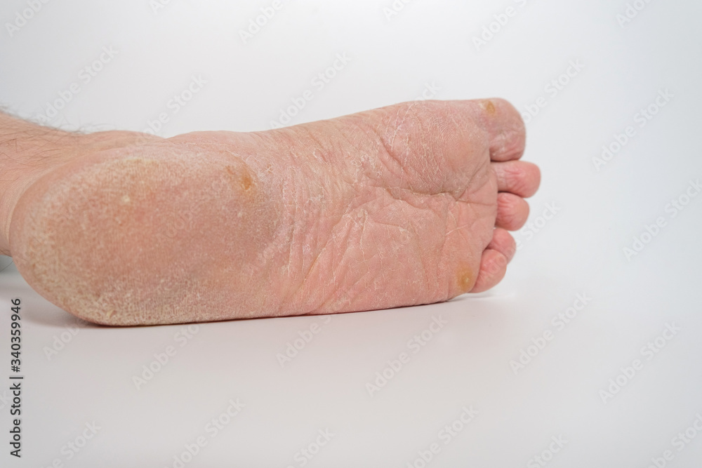 Fungus of the foot of a person.