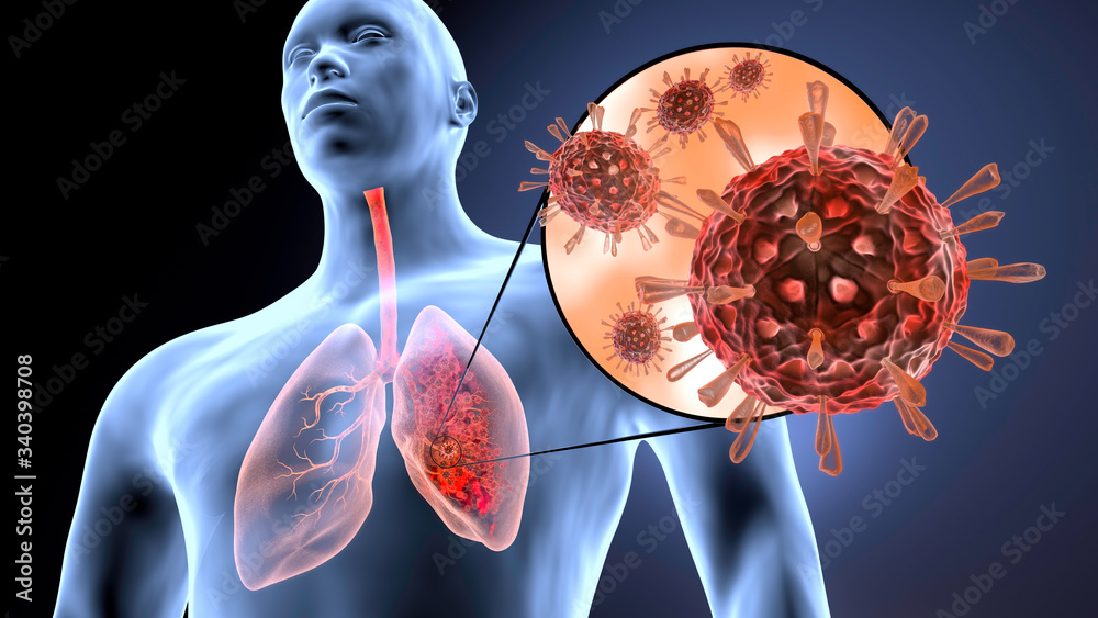 Coronavirus attacks human lungs and causes pneumonia. Lung infection - covid-19, vcov 2019. Microscope virus close up - 3d render. Stock Illustration | Adobe Stock