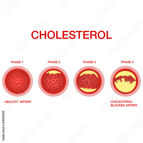Atherosclerosis stages.The accumulation of cholesterol in the blood vessels. Atherosclerosis. Illustration isolated on white background.Atherosclerosis of blood vessels. Cholesterol in the arteries