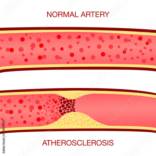 Healthy and atherosclerosis vessels with blood cells vector illustration.The accumulation of cholesterol in the blood vessels. Atherosclerotic plaque. Medical poster.