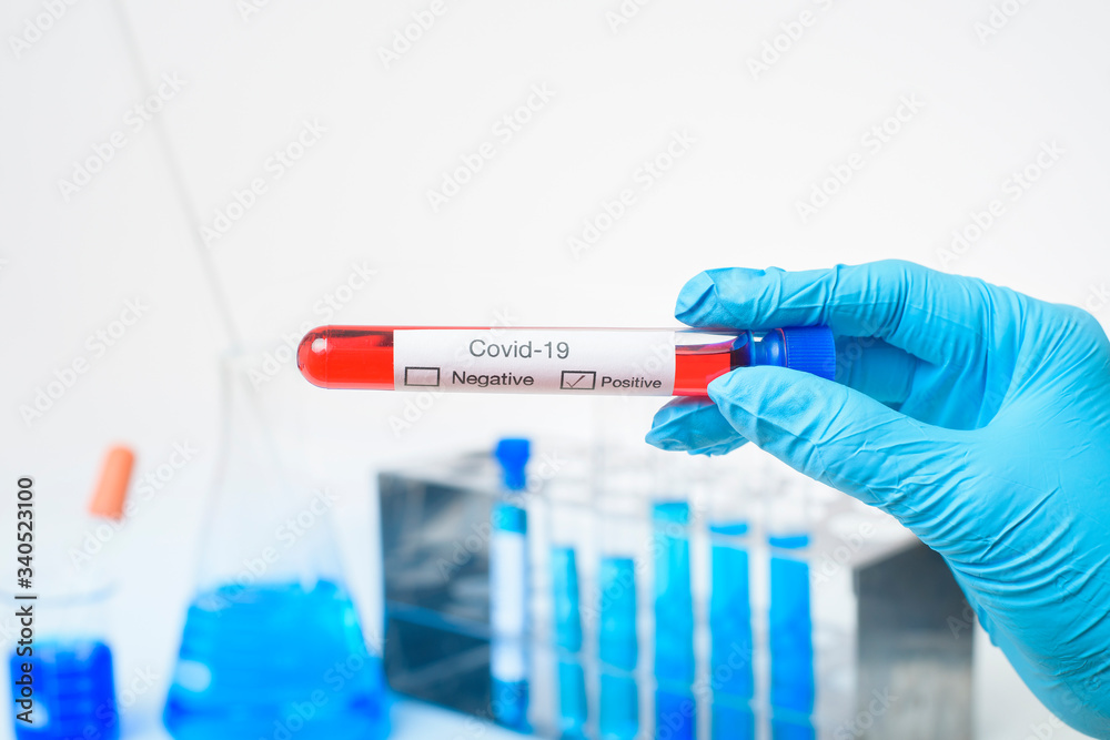 laboratory assistant hand is holding blood test infected Covid-19 laboratory assistant hand is holding blood test infected Covid-19