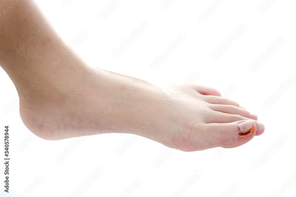 foot with ingrown nail, treatment of ingrown toenail and toe with