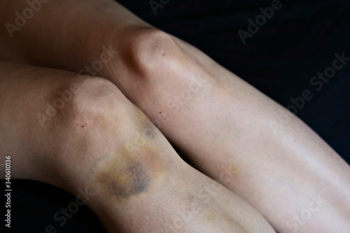 A large bruise on a woman s leg. Violence against women concept image. 