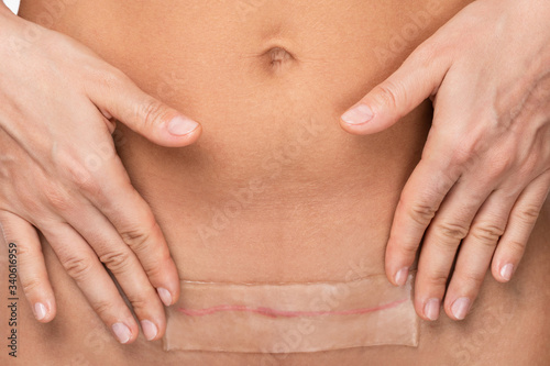 Applying patch with a silicone sheeting on her scar after C-section surgery