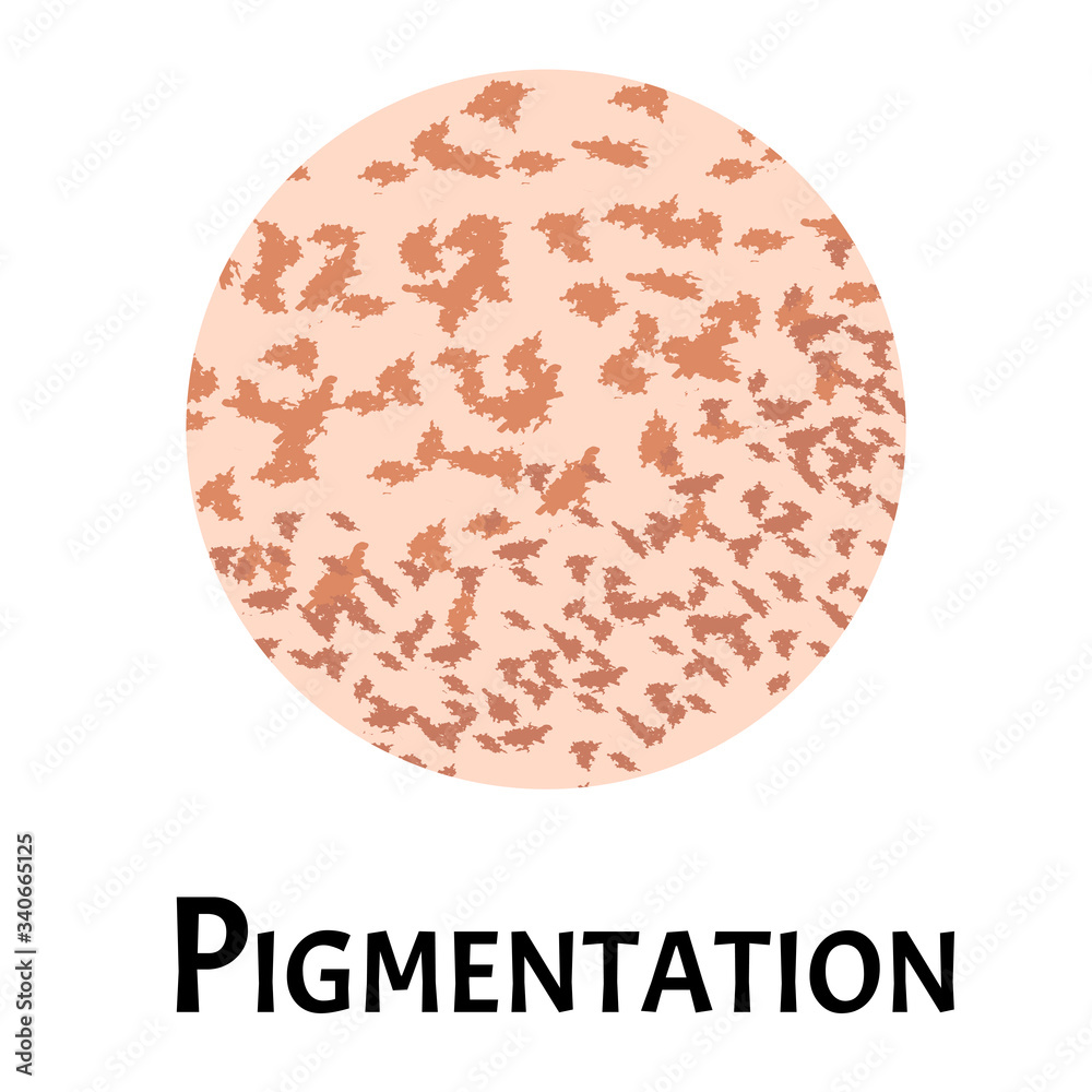 Pigmentation on the skin. A pigmented spot on the skin of the face. Vector illustration Pigmentation on the skin. A pigmented spot on the skin of the face. Vector illustration