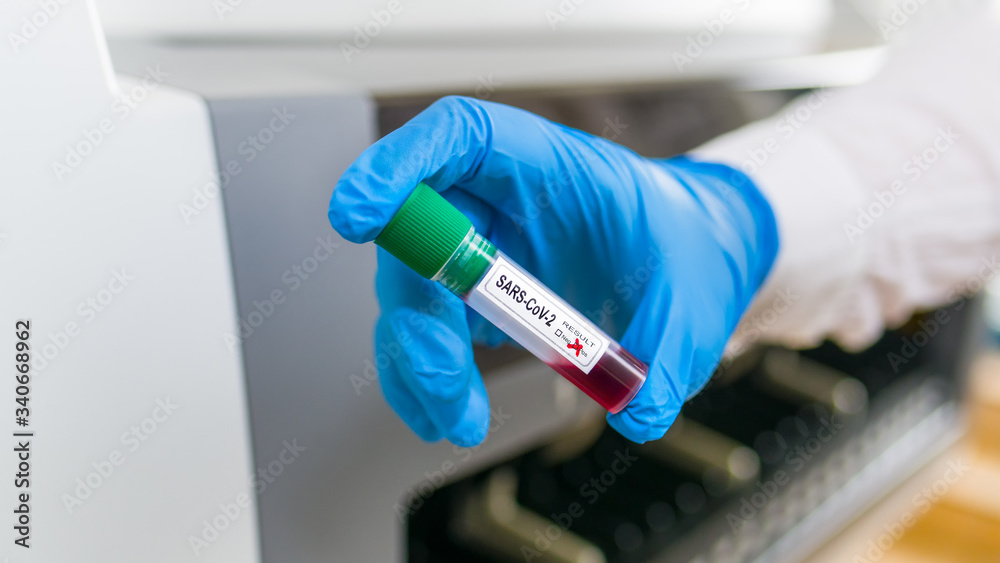 SARS-CoV-2 blood sample in test tube. Coronavirus diagnostic laboratory. Hand in blue protective glove holding vial with COVID-19 positive result in lab with blurry automated analyzer. Viral pandemic.