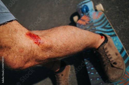abrasion on human leg after skateboard accident