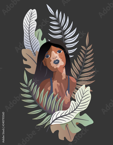 Vector unusual illustration of a dark-skinned vitiligo girl. Tropical style. Light spots on the skin, unusual skin, body positive. Fashionable picture for articles, web sites, t-shirt design.