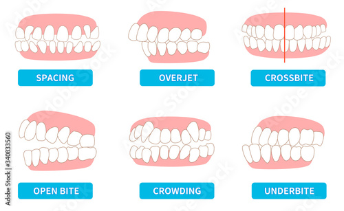 
List of dentitions that require treatment: crowding, opposite occlusion, open bite, maxillary anterior protrusion, cavities, dentition photo