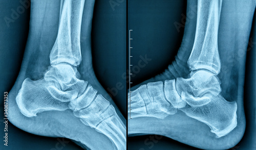 X-ray of human heel spur photo