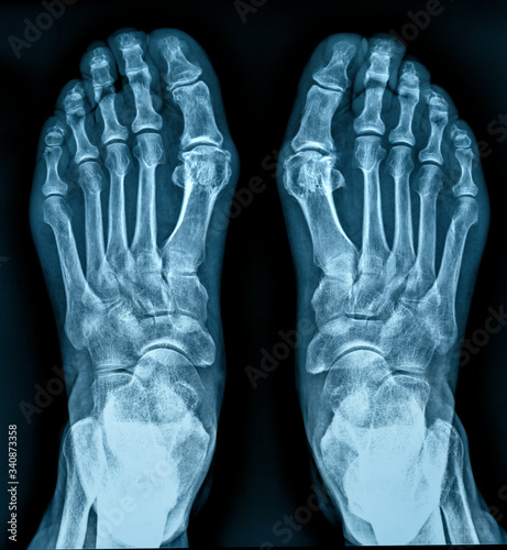 Classic x-ray image of human feet