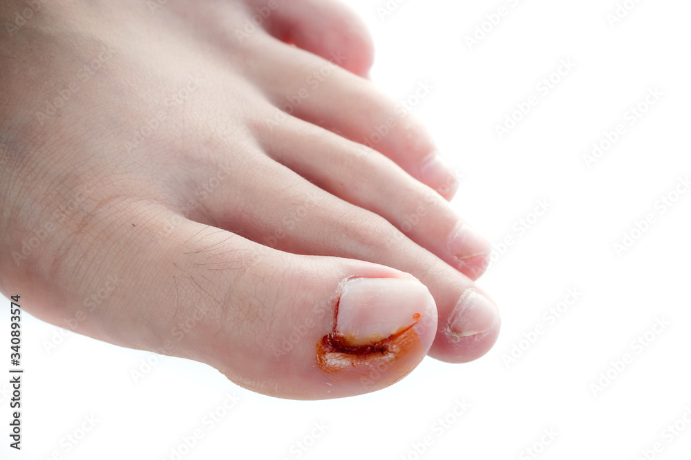 Toenail Pus Videos at Martha Kerley blog
