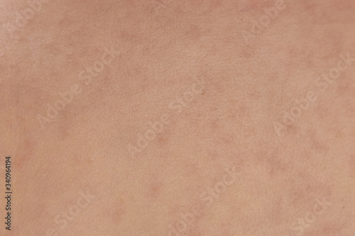 Wallpaper Mural roseola rash a viral rash on the skin of a child Torontodigital.ca