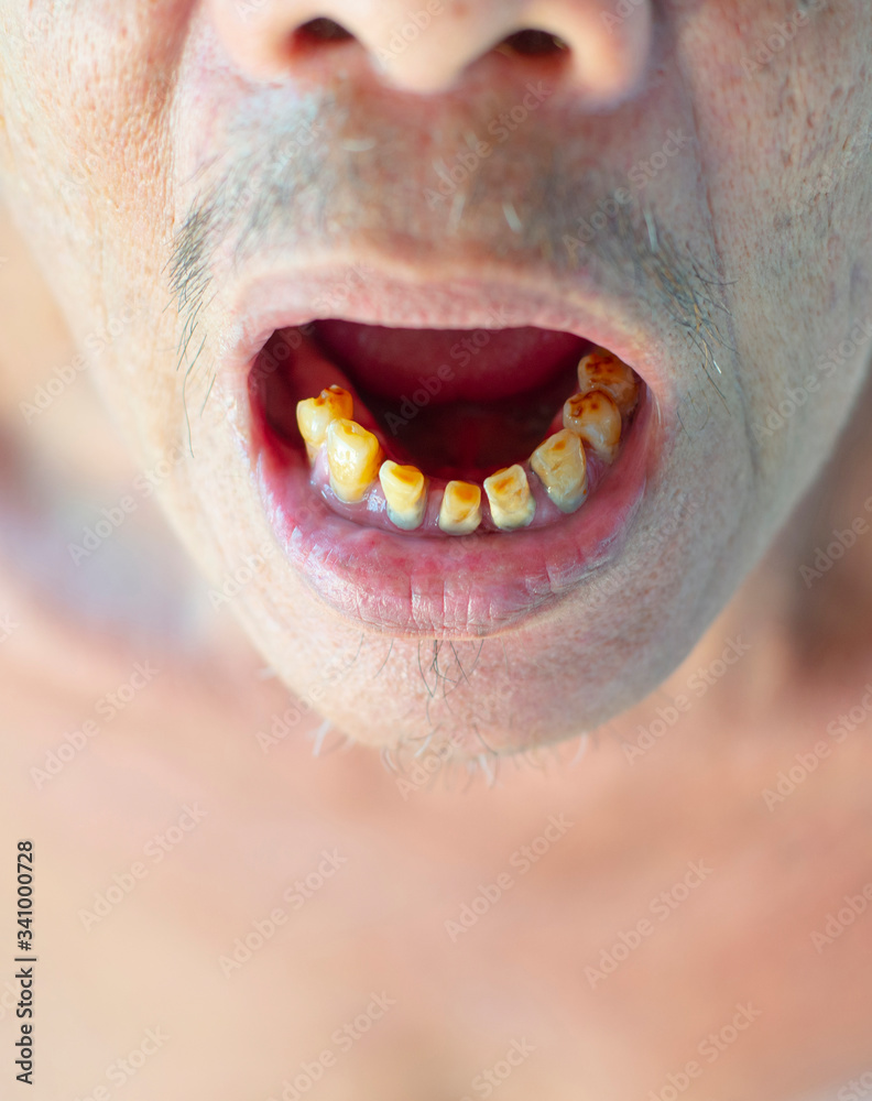 Teeth and gums are deformed and have unattractive plaque.