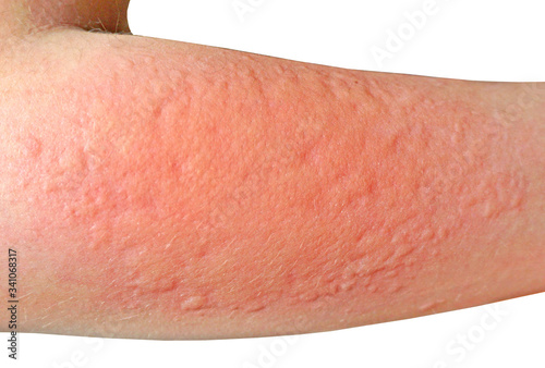 allergic reaction on the skin photo