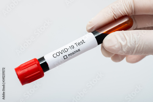 Coronavirus 2019-nCoV Blood Sample. blood for corona, covid-19 virus examination, collected to do a battery of laboratory tests.