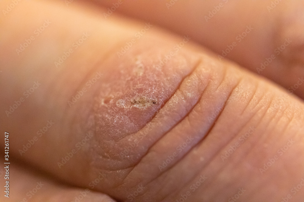 Fingerverletzung Kratzer Fingerverletzung Kratzer