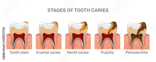 Tooth caries structure and full placement steps in realistic style. Stain, enamel caries, dentil, pulpitis, periodontitis. Gingiva .Vector illustration 3d.