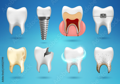 Teeth big set in 3d realistic style. Realistic healthy tooth, dental implant, caries, brocken , calculus, braces.