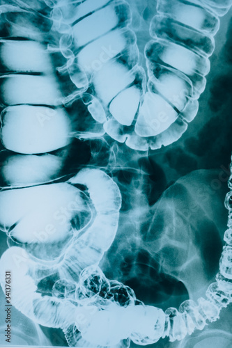 Obraz na plátně X-ray intestines close-up
