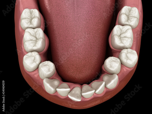 Overcrowded teeth, abnormal dental occlusion. Medically accurate tooth 3D illustration photo