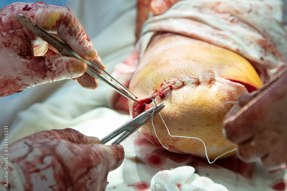 Ταπετσαρία Surgeon finishes sewing the stump after leg amputation close-up