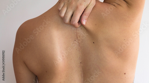  Scoliosis of the spine. Woman's back with a scar from spine surgery. 